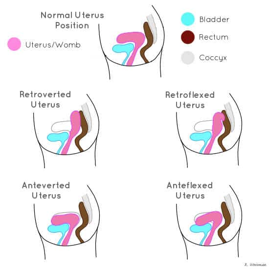 The different uterine position
